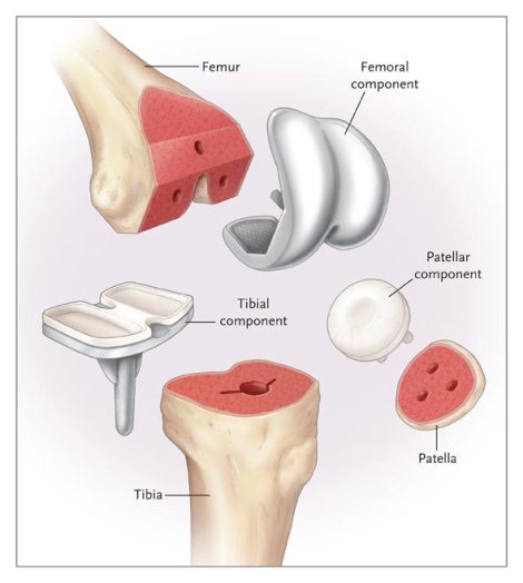 components-of-total-knee-arthroplasty