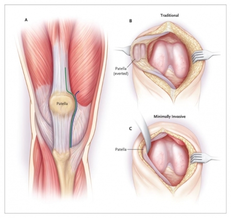 elements-of-minimally-invasive-total-knee-arthroplasty