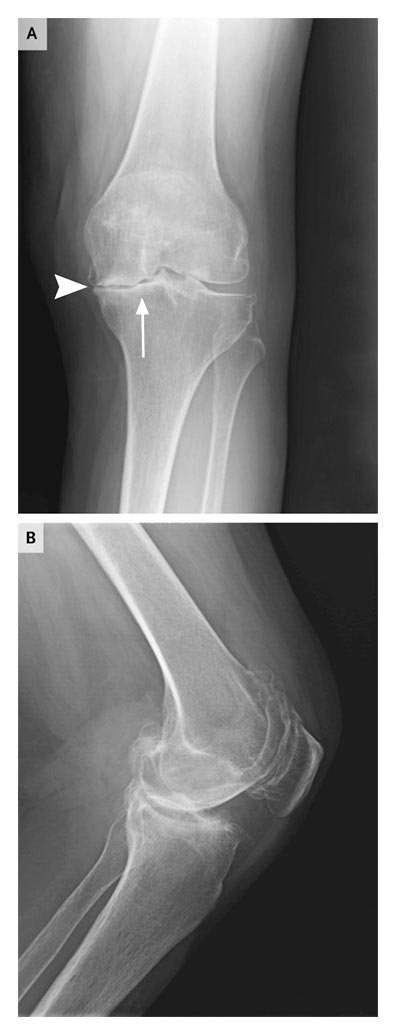 radiograph-of-the-left-knee-of-a-patient-with-osteoarthritis