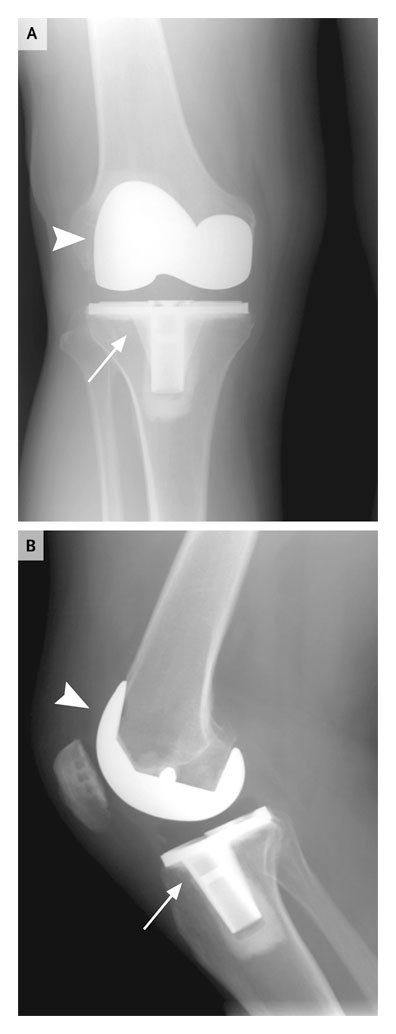 radiograph-of-the-right-knee-of-a-patient-after-total-knee-arthroplasty